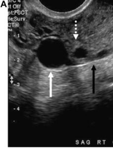 septation DDX hydrosalpinx (April 2010) Paraovarian / paratubal cysts Ductal remnants Cannot differentiate between the two Can develop anywhere along the adnexa Broad ligament Mesosalpinx Surface of