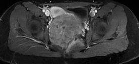 elevated CA 125 Pelvic MRI or short term US Complex masses Endometriosis