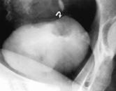 septations Bilateral pelvic