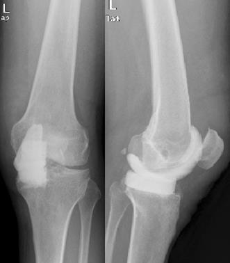 persistent pain the presence of MSSE in 1/3 arthrocentesis in the