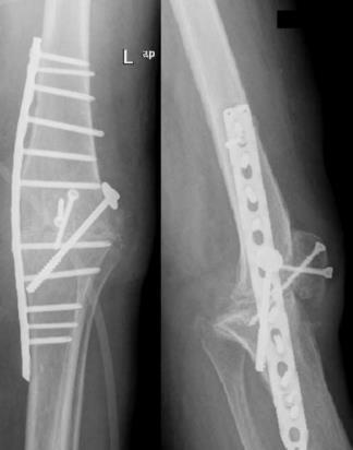 Study Follow-up: failure: PATIENT NR 13 Followed by recommendation of some authors : removal of prosthesis or arthrodesis