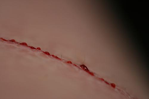 Wound Healing Clean, uninfected surgical incision approximated by surgical sutures Healing by first intention or primary union The incision causes only focal disruption of