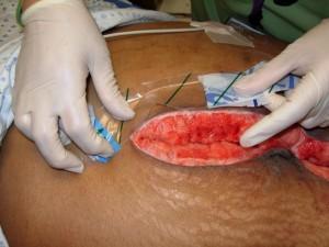 Wound Healing Large wounds, abscess formation, ulceration, infarction Pressure ulcer of the skin, commonly