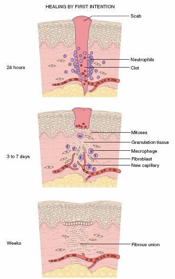 Wound Healing by First Intention Neutrophils are seen at the incision margin, migrating toward the fibrin clot. Basal cells of the epidermis begin to show increased mitotic activity.