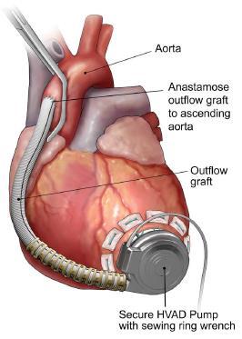 LV-Apical Implantation Anastomose Outflow Graft to Aorta Aorta