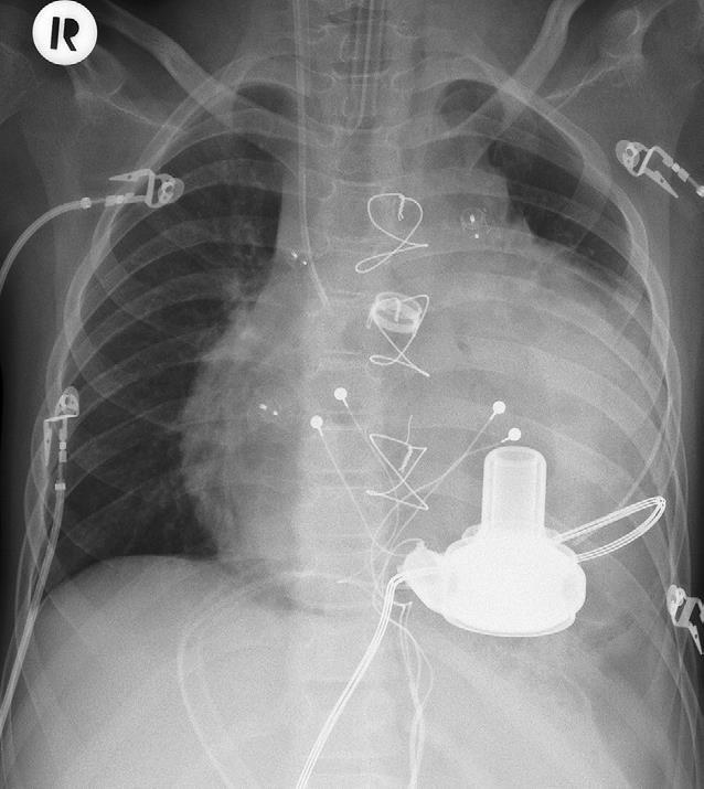 HVAD Implantation in Failing FONTAN: Hypoplastic left heart syndrom S/P Norwood I and