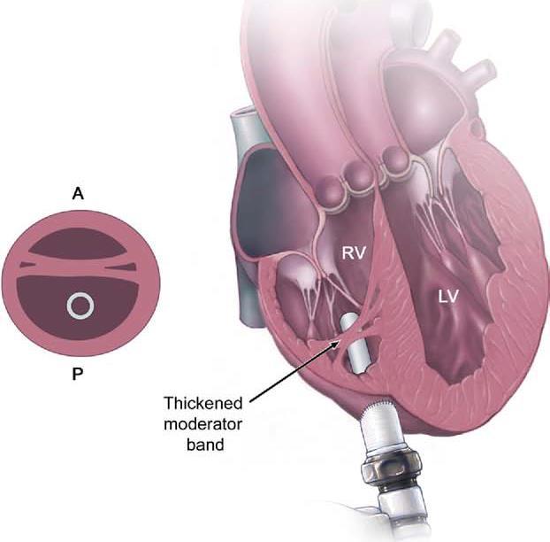 HVAD Implantation systemic right ventricle (Transposition