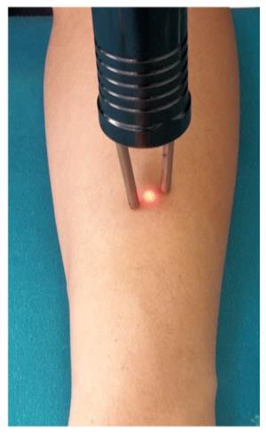 Methods Laser stimulation of the forearm.