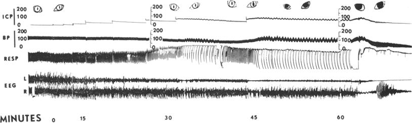 Increased CSF Pressure: Vital Signs 19 FIG. 3. The entire recording, excluding those few minutes with faster speed. Note the sequential alteration of the EEG, respiration, pupils, and blood pressure.