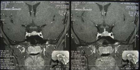 MRI scan of brain (post contrast). Table 1.