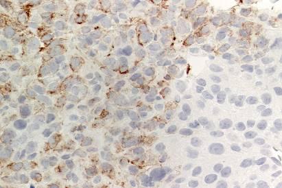 carcinoma Adrenal cortical carcinoma Small cell carcinoma CK8: