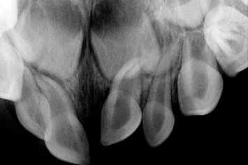 Complete intrusion. a: radiograph at 3.