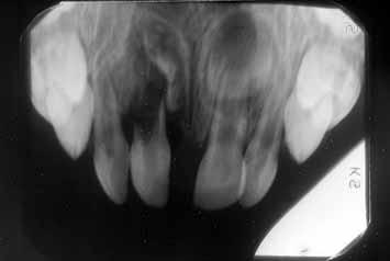M. L. ODERSJÖ, G. KOCH a b c FIG.5 - Girl 9 months at the time of trauma. All primary maxillary incisors intruded to half of the crown. a: radiograph 3 months after trauma.