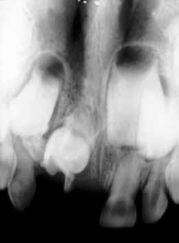 Note odontoma-like malformation of crown 11, tendency to pre-eruption and early root formation. c: radiograph at 7.5 years of age. Note the rapid development of the root 11.