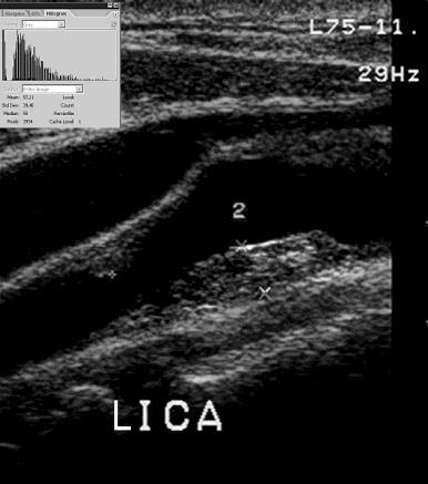 Imaging of The Vulnerable Plaque Ultrasound Gray Scale Median (Computer analyzed global echogenicity