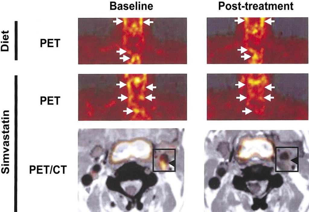 Imaging of The Vulnerable Plaque High