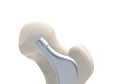 Preparing the Femoral Canal A rectangular box chisel is used to cut a slot in the