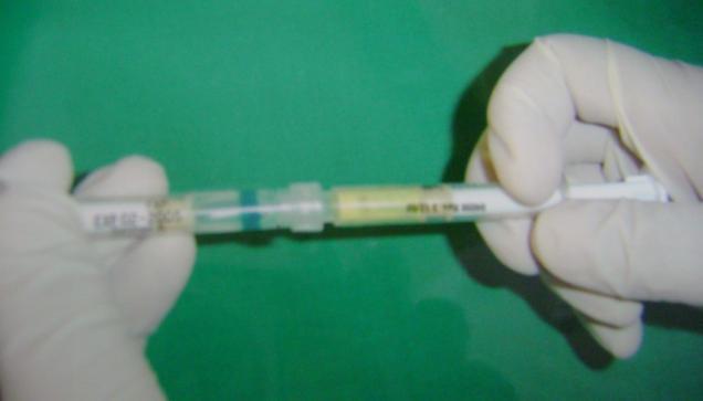 The cannula was inserted up to base of the pocket and the gel was pushed until it reached top of the gingival margin (Figure-3). The cannula tip was withdrawn from the pocket very gently.