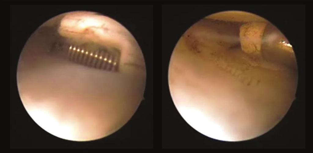 2 Case Reports in Orthopedics Figure 1: Arthroscopy of both knees was performed, followed by arthroscopic partial meniscectomy with a high-frequency electric knife for both knees.