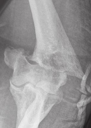 Two patients had grade 1 open fractures [11]. Three non- or minimally displaced transcondylar fractures were treated with cast immobilization.