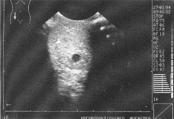 Testicular ultrasonography showing a Leydig cell tumour Leydig cell tumours cause elevated T