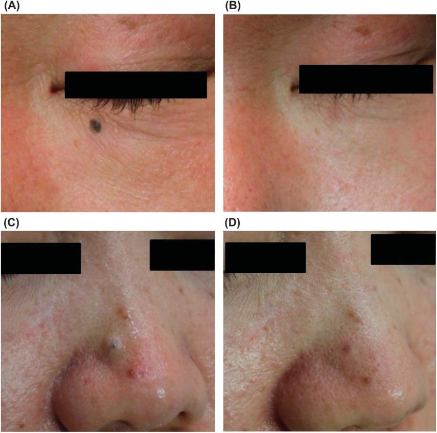 LEE ET AL change in skin texture was reported in 7 of the treated nevi (10.8%) (4 junctional and 2 compound AMN and 1 CMN).