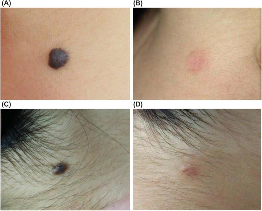 ER:YAG AND LONG-PULSED LASER FOR MELANOCYTIC NEVI There is no gold standard for the treatment of small benign melanocytic nevi for cosmetic purposes.