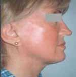 lesions, such as port wine stains, hemangiomae, warts, telangiectasiae, rosacea, venous lakes, leg veins and spider