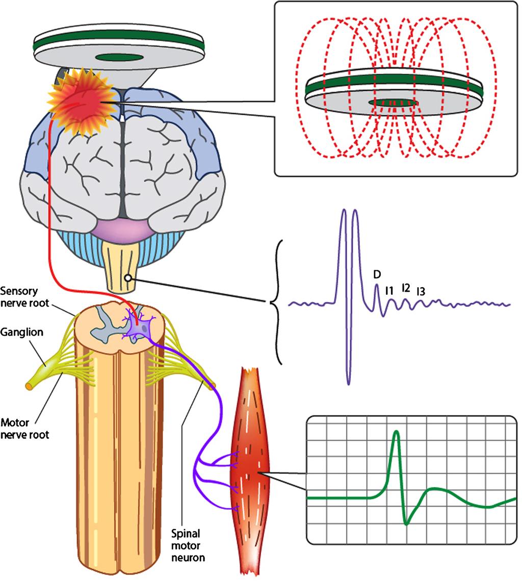 TMS and Neurodegenerative Disease 93 Fig. 1 Transcranial magnetic stimulation evokes a descending corticospinal volley composed of direct (D) and multiple indirect (I) waves.