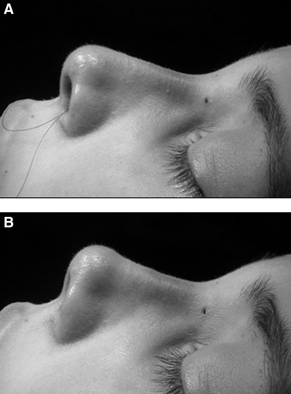 Annals of Plastic Surgery Volume 59, Number 3, September 2007 FIGURE 4. A, B, Before and after the application of the septocolumellar suture on another patient.