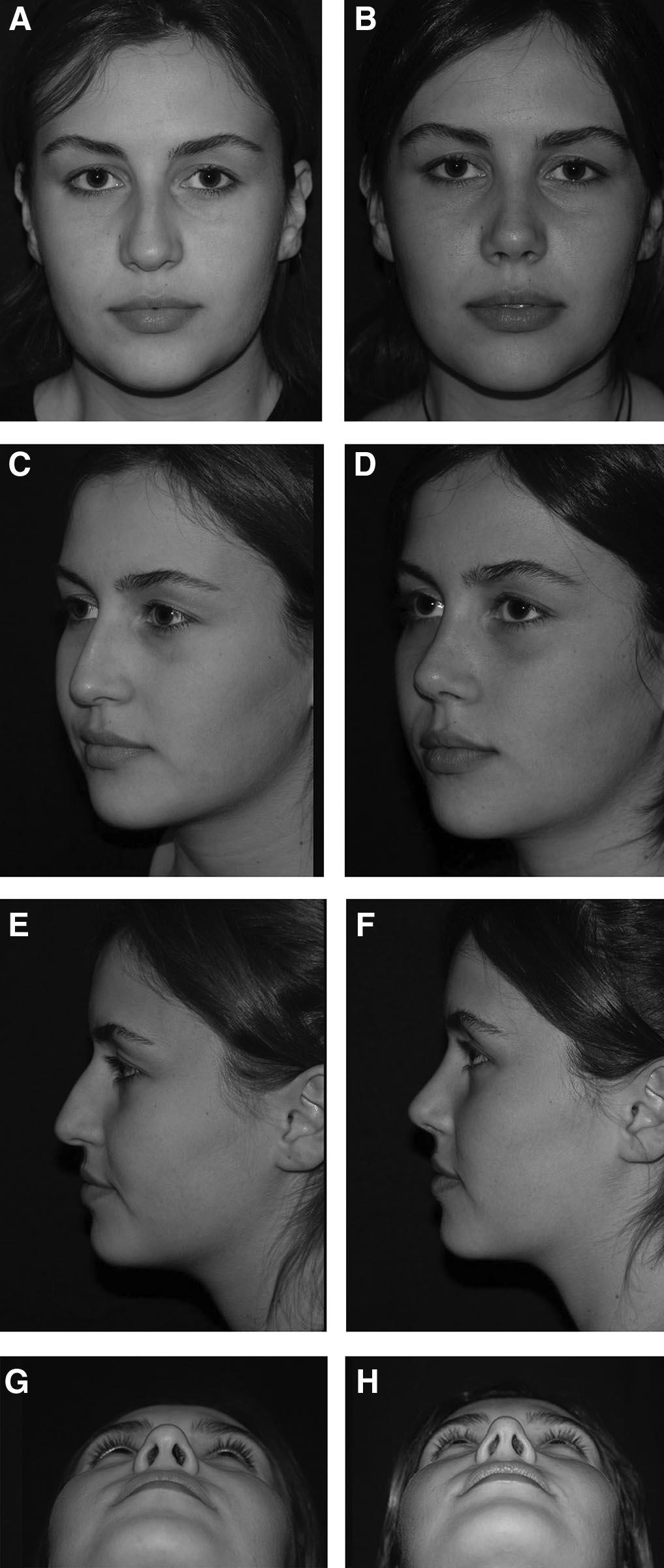 A single septocolumellar suture alone is capable of preventing these major drawbacks of closed rhinoplasty and decreases the need for open rhinoplasty in most cases, therefore limiting the dissection