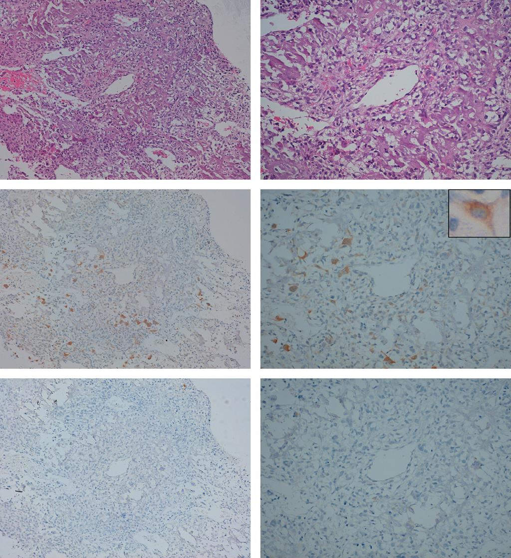 IDH2 Mutation in Osteosarcoma X. Liu et al. A B C D E F Figure 3. Immunohistochemical analyses by MsMab-1 against osteosarcoma tissues.