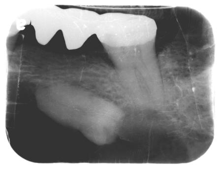 radiography There is a well-defined unilocular ovoid shaped radiolucence with a corticated margin over an embedded horizontal tooth over the left mandible body, extending from root apex