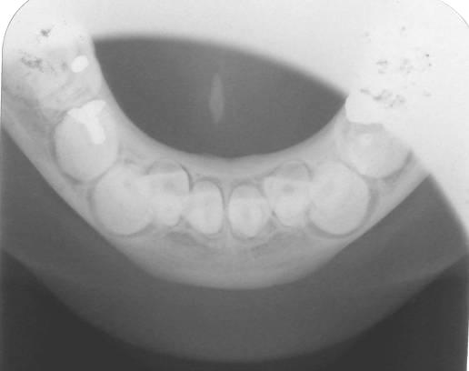 Image No. 009 Sialolithiasis, anterior mouth floor Main X-ray findings This is an occlusal projection of lower anterior mouth floor.