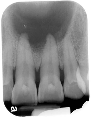 radiolucency with a thin corticated margin, extending from tooth 13 apex to tooth 23 apex and from one-third of intermaxillary suture up to palatal