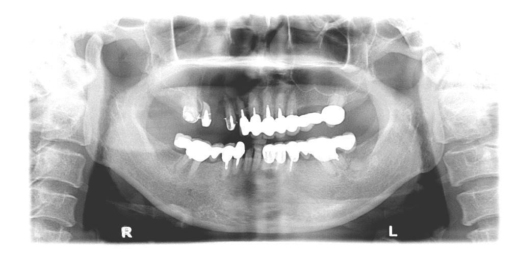 Image No. 003 (1) Calcifying odontogenic cyst over right maxilla (2) Osteosclerosis over left lower retromolar area Main X-ray findings (Panoramic radiography) There are three major abnormalities.