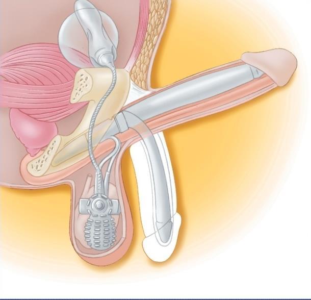 Three Piece Inflatable Penile Implant Advantages Same advantages as the two - piece plus: