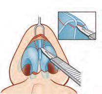 First the soft tissues over the nasal dorsum are undermined with a scissors and a No. 15 blade through an open approach (Fig. 17).