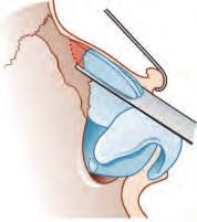 A suction dissector may be a helpful tool at this stage (Fig. 19). When both tunnels have been developed, the bony and cartilaginous hump can be taken down as needed.
