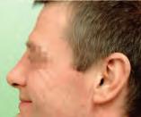 asymmetry of the nasal tip (Fig.