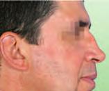 54 Saddle nose deformity and