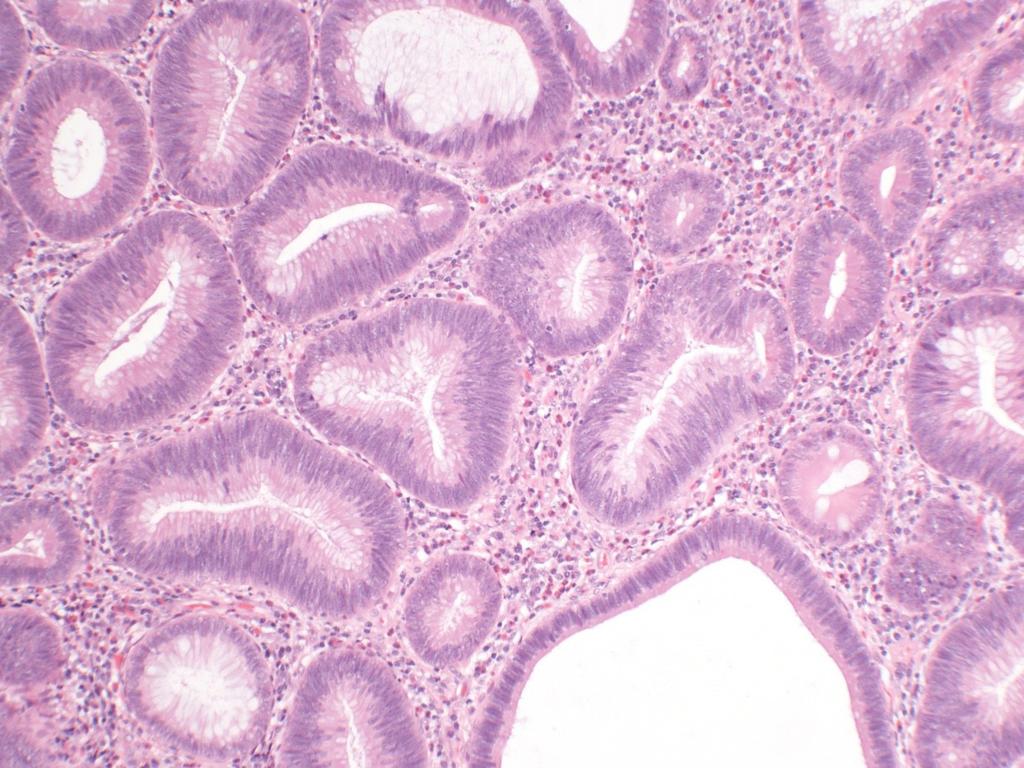 A Figure 1A: Features of low-grade epithelial dysplasia with mild cellular stratification of glands.