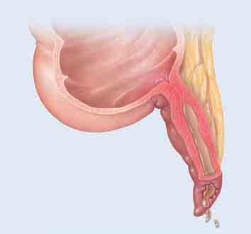 When Problems Occur Inflamed appendix Inflammation Colon An appendix may become