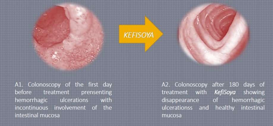 Human Study: Kefi-soy on Crohn s Disease & Colitis Sample A: 45 year old male with