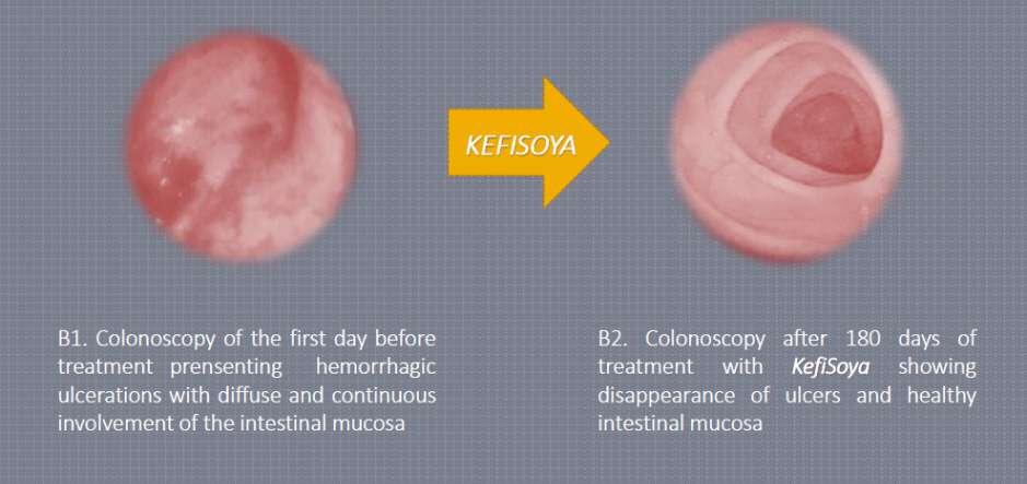 Human Study: Kefi-soy on Crohn s Disease & Colitis Sample B: 60 year old female with