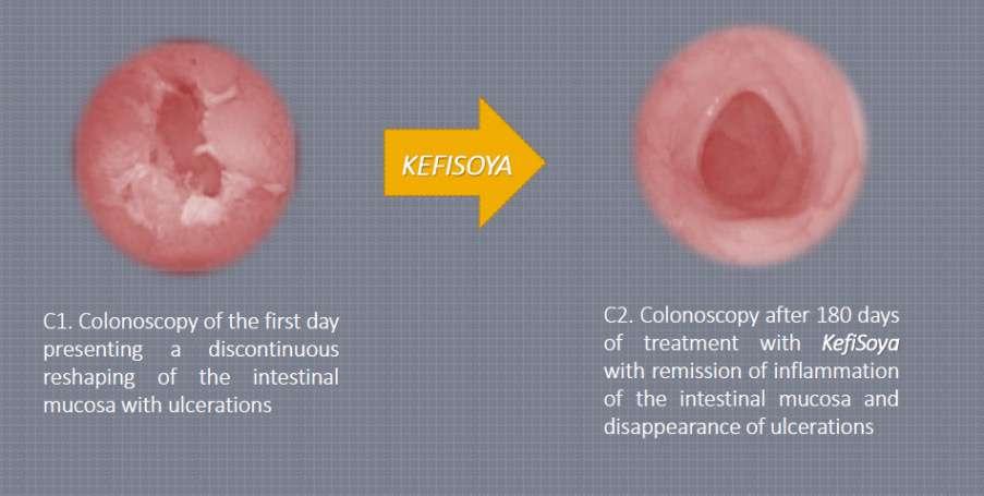 Human Study: Kefi-soy on Crohn s Disease & Colitis Sample C: 36 year old male with