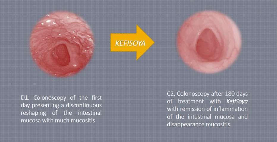 Human Study: Kefi-soy on Crohn s Disease & Colitis Sample D: 50 year old male with