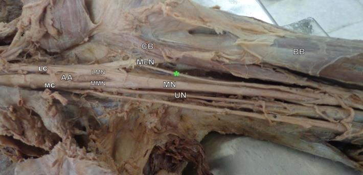 instead of piercing the coracobrachialis, the musculocutaneous nerve continues the median nerve before dividing at various levels.