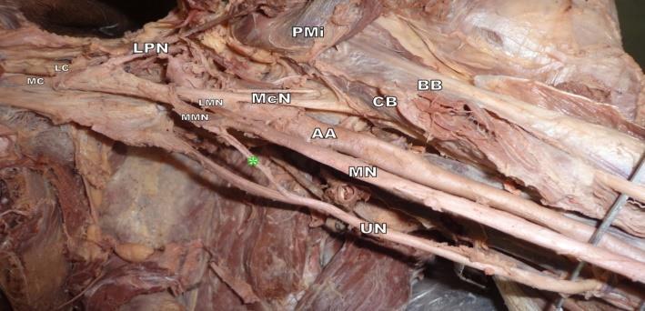 *Communicating branch; Cb: coracobrachialis; Pmi: pectoralis minor; Bb:biceps brachii; Lmn: lateral root of median nerve; Un: ulnar nerve; Mn: median nerve; Mcn: musculocutaneous nerve; Mc: medial