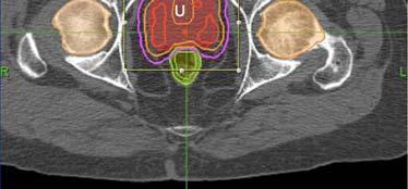 UCSF 2012 Stereotactic body radiotherapy as monotherapy or post external beam radiotherapy boost for prostate cancer: technique, early toxicity, and PSA response. Jabbari S, et al.